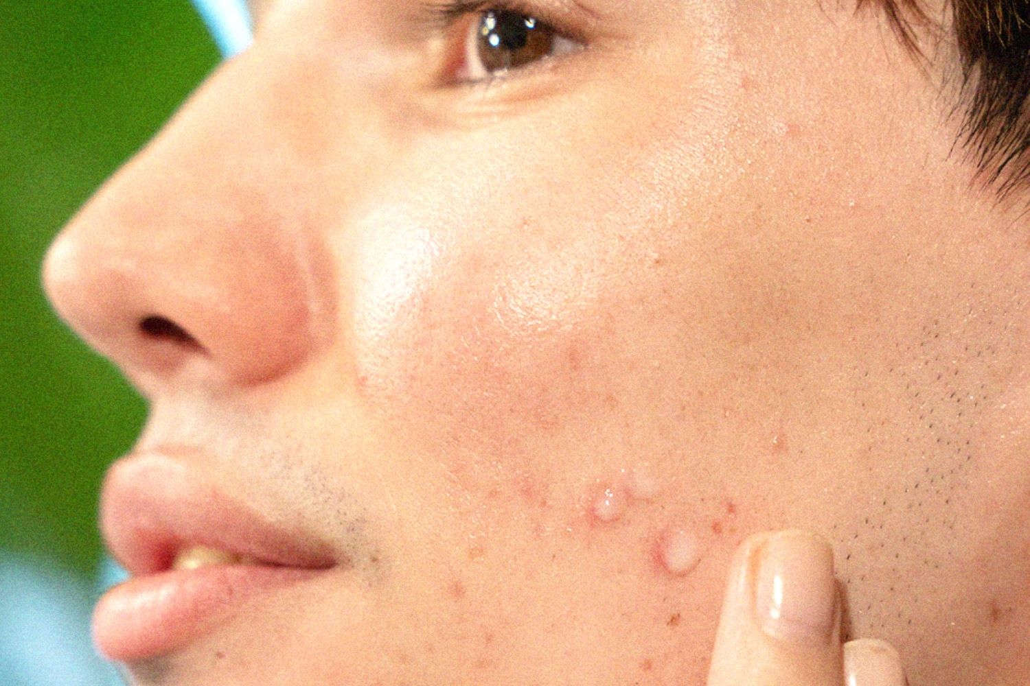 rolling acne scars